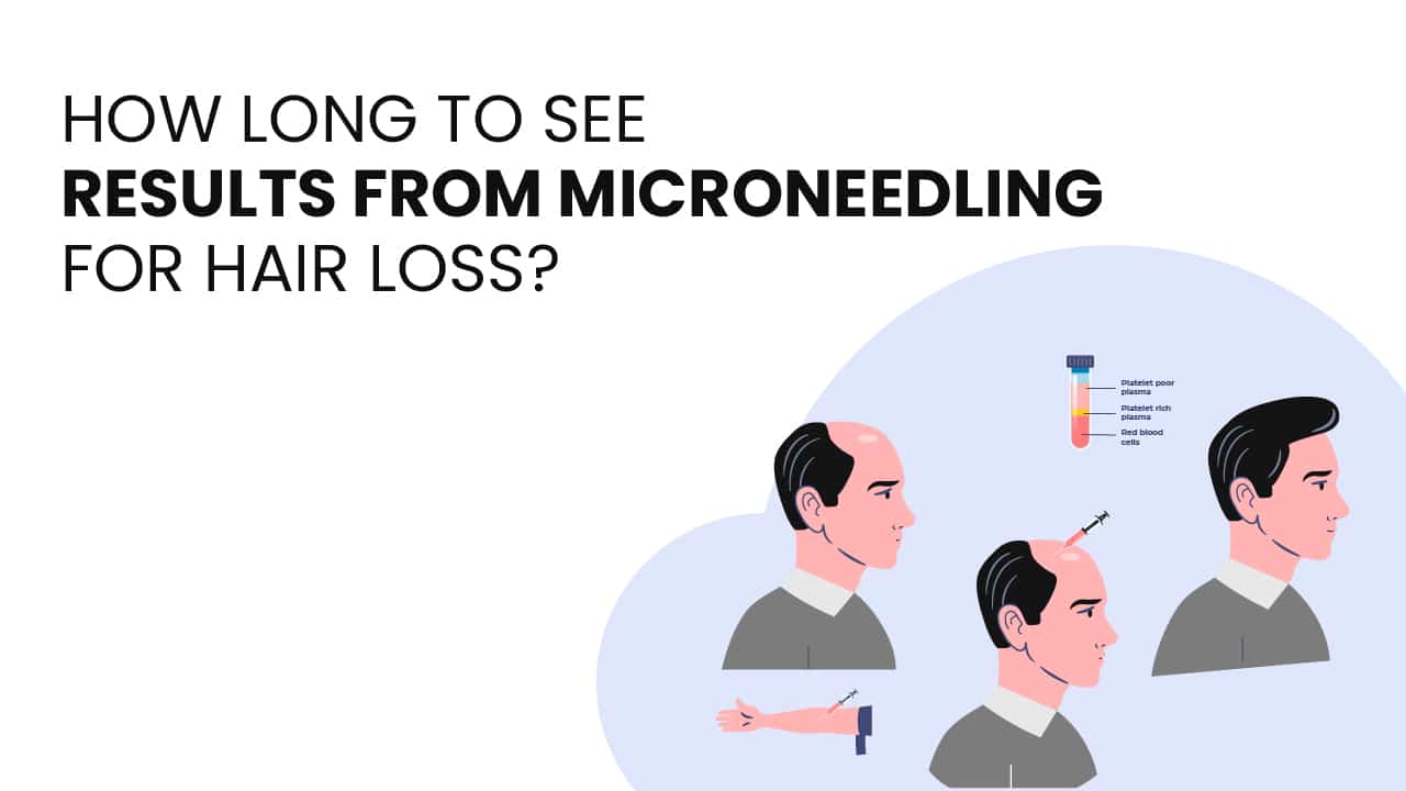 How long to see results from microneedling for hair loss