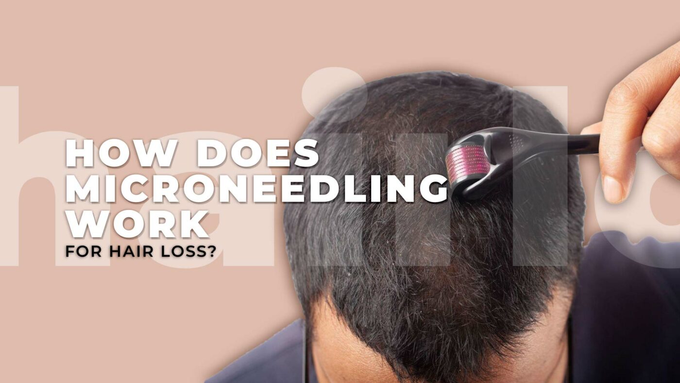 2. How does microneedling work for hair loss